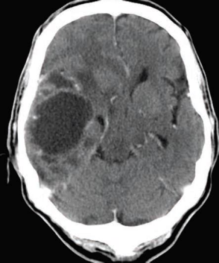 glioblastoma multiforme icd 10 cm